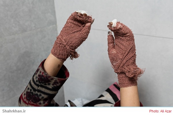 زخم سوختگی