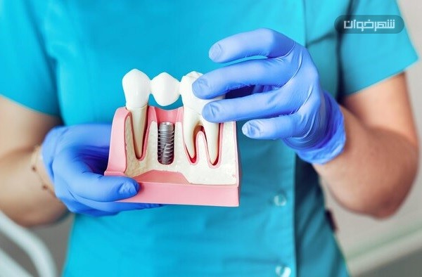 مرکز تخصصی ایمپلنت تهران 5 ایمپلنت دندان implant dentist