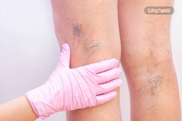 رگهای واریس 1 رگهای واریس varicose-veins